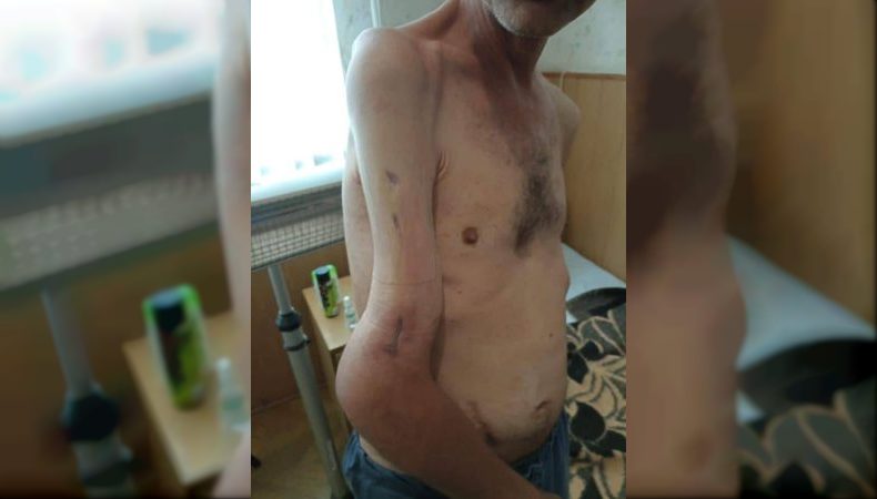 У легендарного захісника «Азовсталі» Михайла Діанова не вистачає 4 см кістки в руці